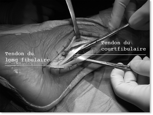 Ligamentoplastie cheville - Chirurgie Orthopédique Nice - Dr