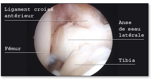 Anse de seau méniscale latérale vue sous arthroscopie
