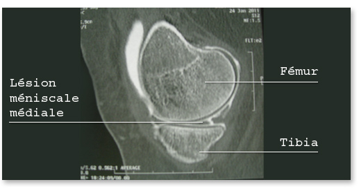 arthroscanner-du-genou