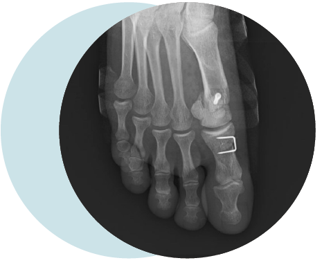 L’hallux valgus est une pathologie évolutive, avec une aggravation progressive de la déformation