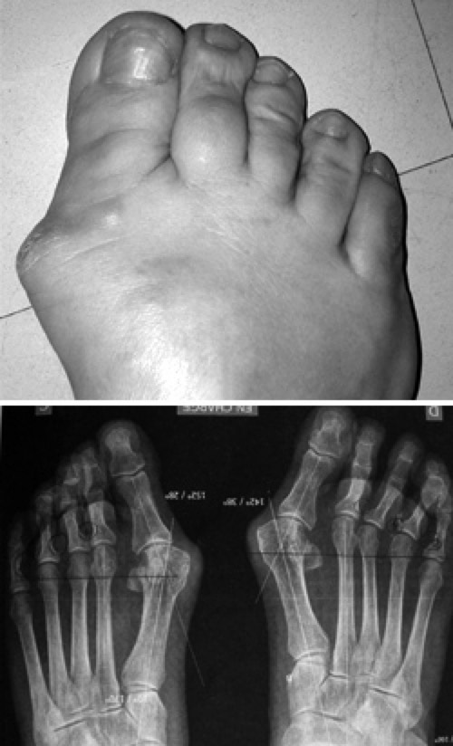 chirurgie-hallux-valgus
