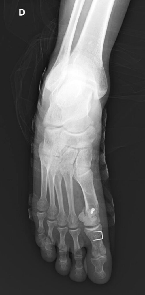hallux-valgus-chirurgie