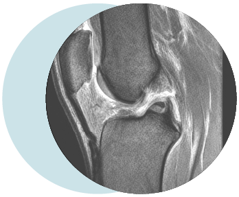 les lésions ligamentaires du genou@1.5x