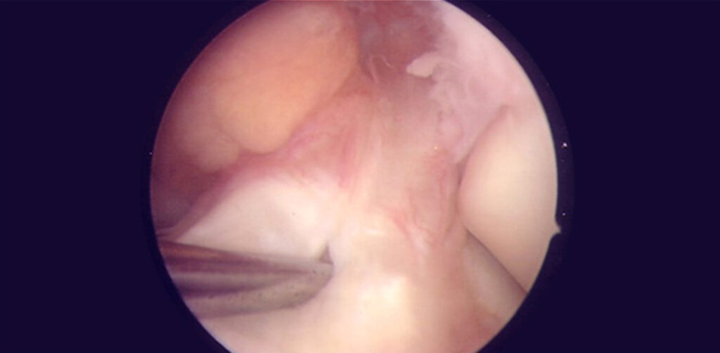 ligament-croise-anterieur