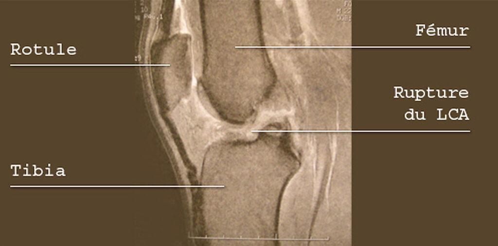 ligament-croise-anterieur