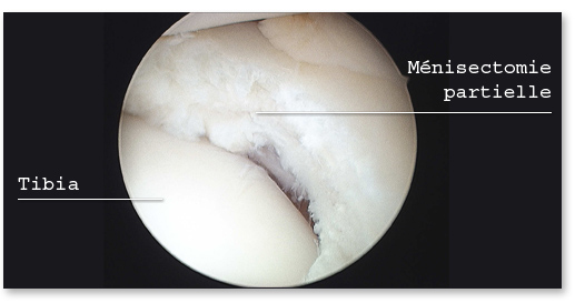Ménisectomie partielle latérale sous arthroscopie