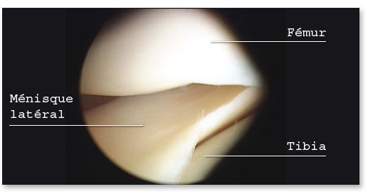 menisque-lateral-sain-vu-en-arthroscopie