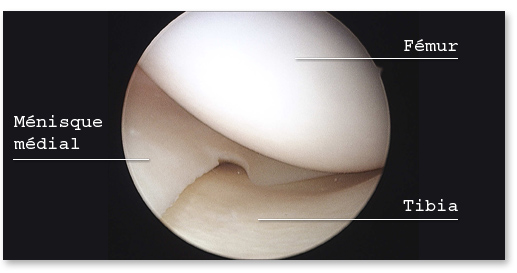 menisque-medial-sain-vu-en-arthroscopie