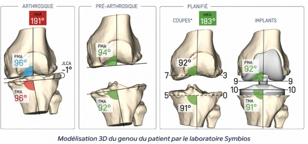 principe-prothese-totale-genou-sur-mesure